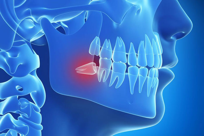 Răng khôn mọc vào độ tuổi trưởng thành từ 17 – 25 tuổi