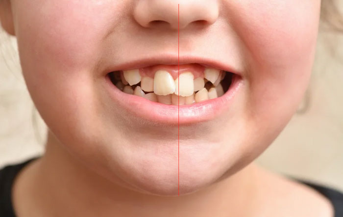 Răng lệch nhân trung là tình trạng bất đối xứng điểm giữa ở một hoặc cả hai hàm