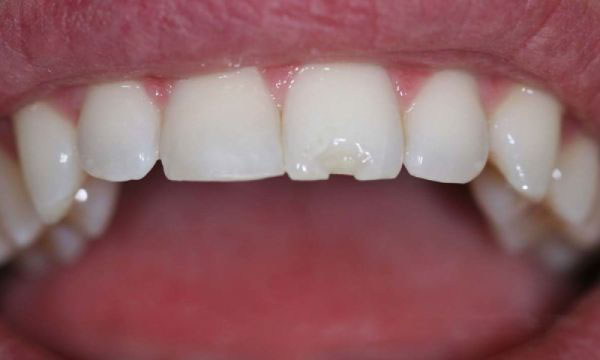 Răng sứ kém chất lượng dễ bị nứt mẻ khi sử dụng