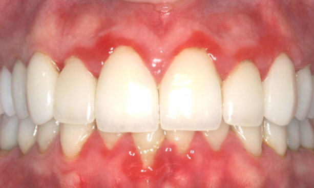 Răng sứ kém chất lượng dễ gây viêm nhiễm, kích ứng