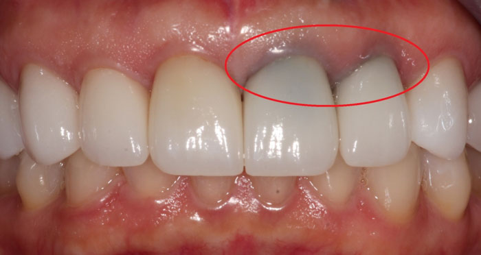 Răng sứ kim loại gây đen viền nướu, đổi màu răng sau một thời gian dùng