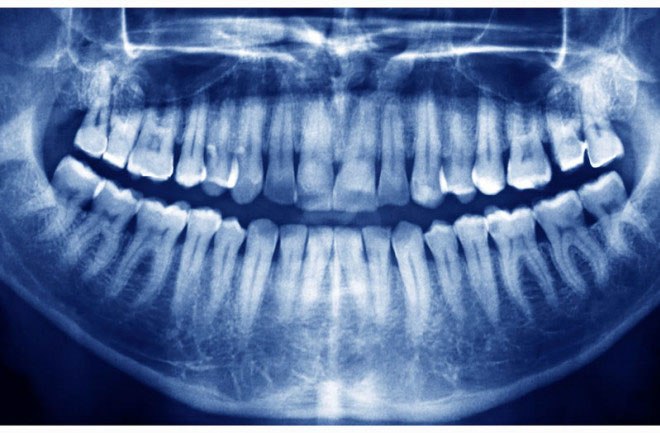 Răng vĩnh viễn thường có 28 – 32 chiếc