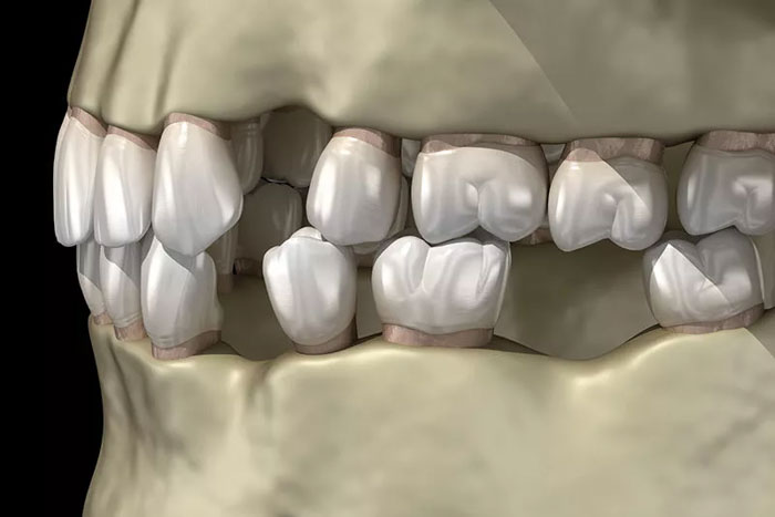 Răng xô lệch và gây ra các vấn đề khớp cắn khi mất răng