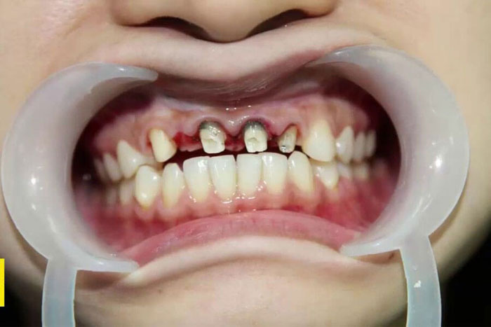 Sau khi bọc sứ bị viêm tủy có thể gây hư hỏng trụ răng thật