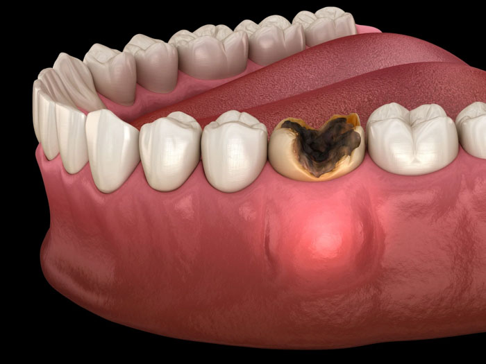 Sâu răng khiến mô răng bị phá hủy nghiêm trọng sẽ phải nhổ bỏ