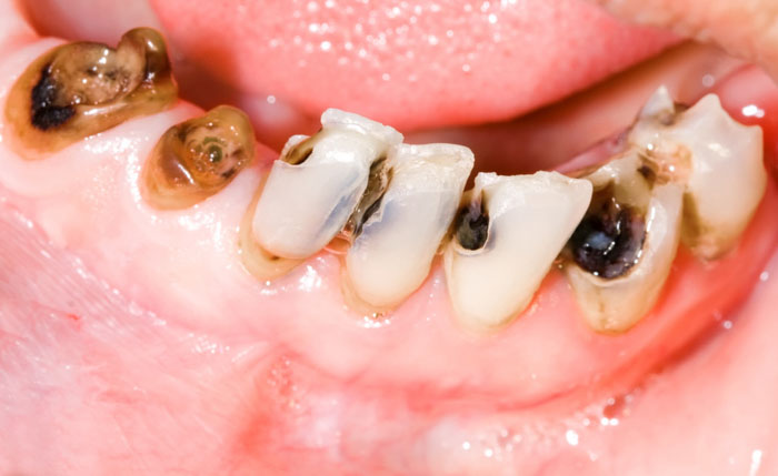 Sâu răng không điều trị sớm sẽ gây nguy cơ mất răng vĩnh viễn