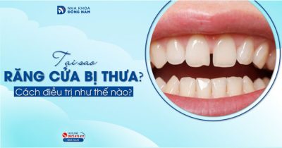 Tại sao răng cửa bị thưa? Cách điều trị như thế nào?