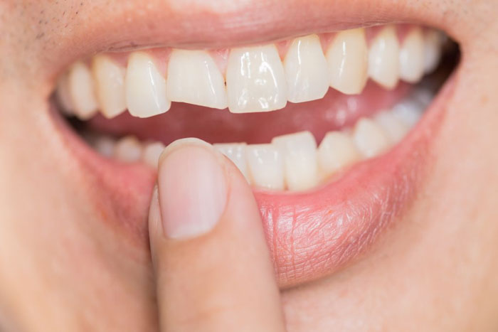 Trám răng cho trường hợp răng sứt mẻ nhỏ