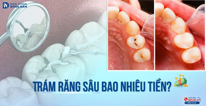 Trám răng sâu bao nhiêu tiền?