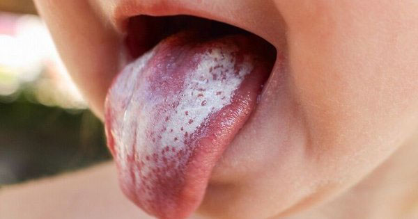 Trẻ nhỏ cũng cần được làm sạch lưỡi mỗi ngày để tránh bị lưỡi trắng