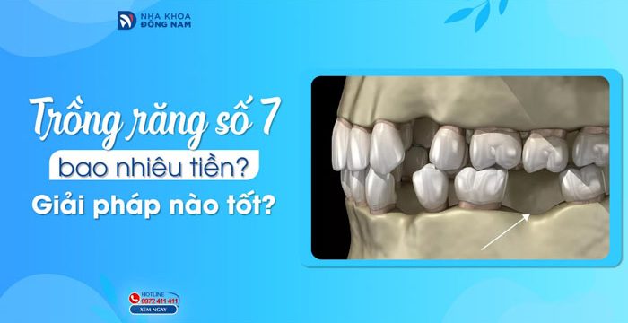 Trồng răng số 7 bao nhiêu tiền? Giải pháp nào tốt?