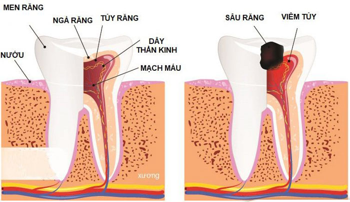 Tủy răng bị viêm nhiễm sẽ gây đau nhức dai dẳng