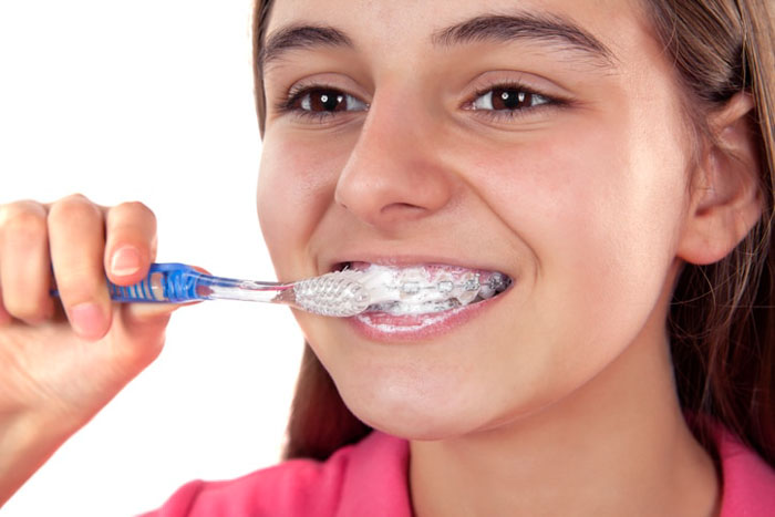 Vệ sinh răng miệng kém khi đeo niềng sẽ rất dễ gây viêm lợi
