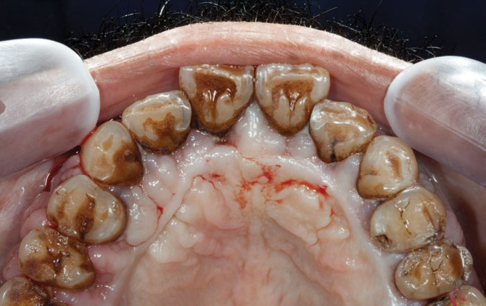 Vết đen trên răng có thể gây viêm nha chu