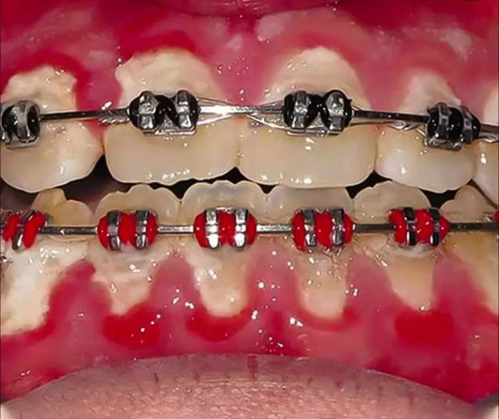 Viêm lợi khi niềng răng tiềm ẩn nhiều biến chứng nguy hiểm