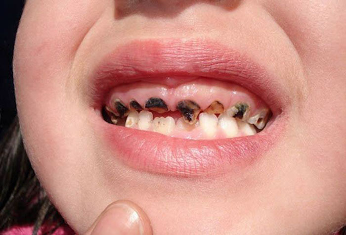 Xiết ăn răng là một bệnh lý thường gặp ở trẻ nhỏ