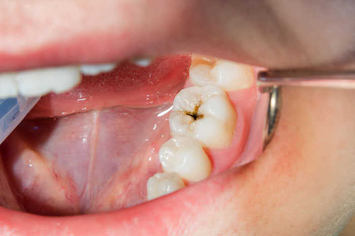 Bề mặt răng hàm nhiều rãnh sâu nên dễ gây sâu răng
