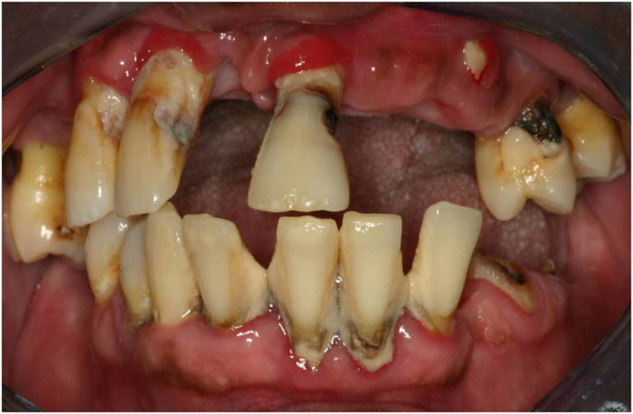 Bệnh răng miệng kéo dài dễ gây nguy cơ mất răng toàn hàm