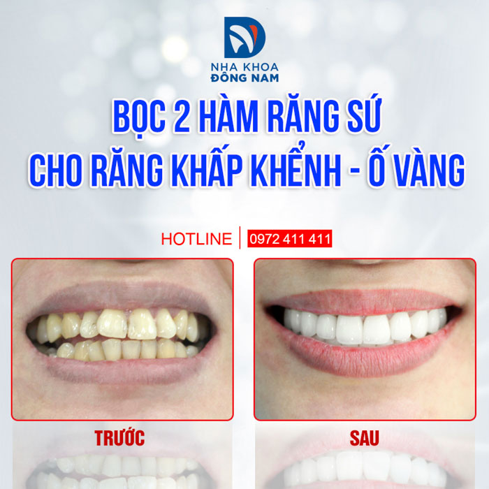 Bọc 2 hàm răng sứ cho răng khểnh - ố vàng