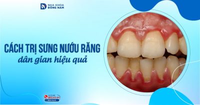 Cách trị sưng nướu răng dân gian hiệu quả