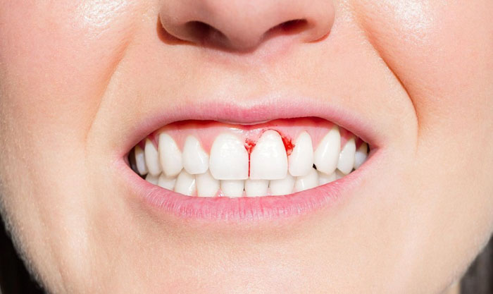 Cần điều trị bệnh lý ở răng miệng trước khi đính đá lên răng