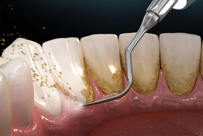 Cạo vôi răng điều trị viêm nha chu ở giai đoạn đầu