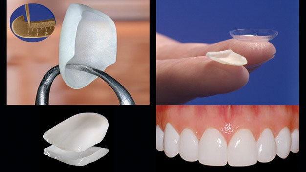 Dán răng sứ có tỷ lệ mài răng cực thấp, đem lại thẩm mỹ tối ưu