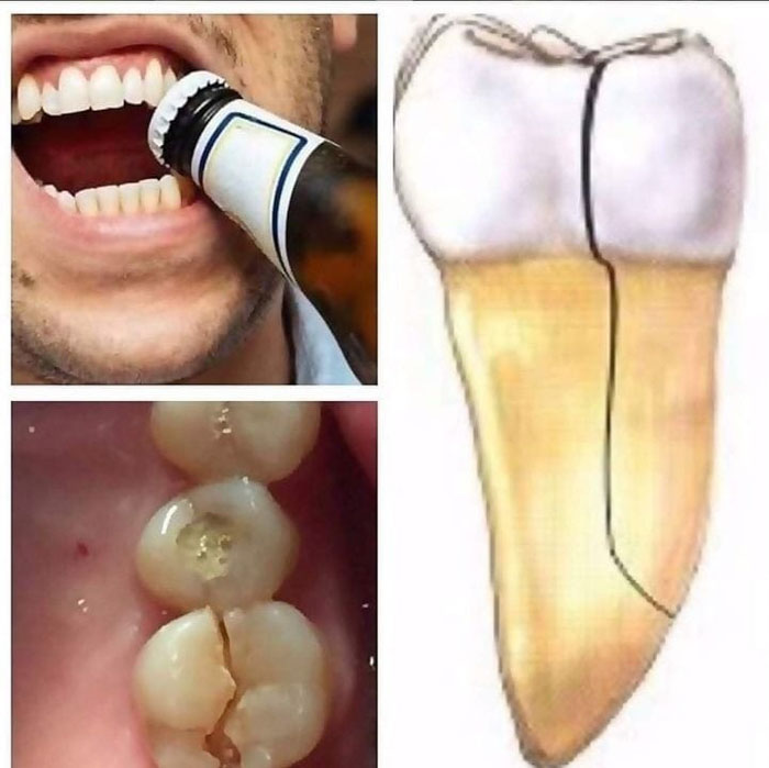 Dùng răng mở nắp chai rất dễ gây sứt mẽ, gãy vỡ răng