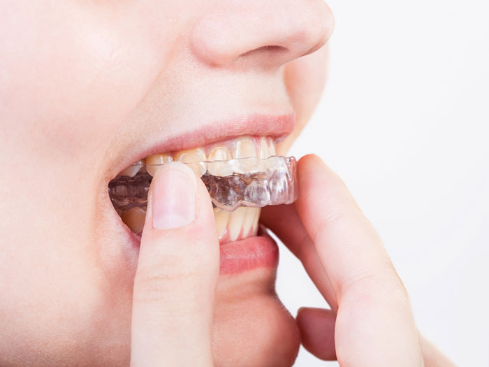Máng chống nghiến giúp cải thiện tình trạng nghiến răng