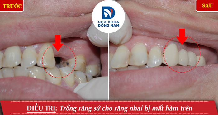 Mão răng sứ áp dụng cho trường hợp bệnh nhân làm cầu răng sứ phục hình răng mất