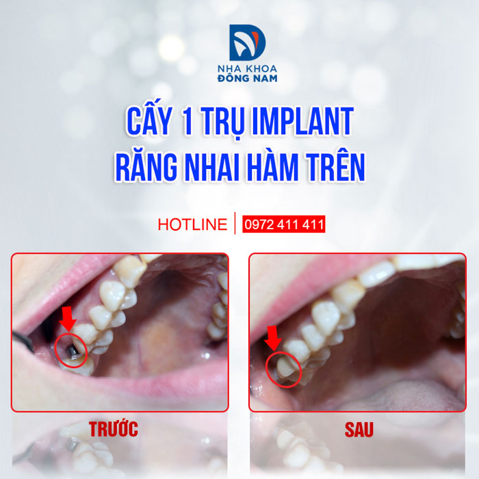 Mão răng sứ dùng để phục hình răng trên Implant