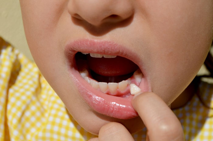Nhổ răng tại nhà chỉ áp dụng cho những chiếc răng bị lung lay nhiều