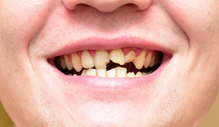 Răng bị nứt gãy cũng khiến bệnh nhân đau nhức, ê buốt dữ dội