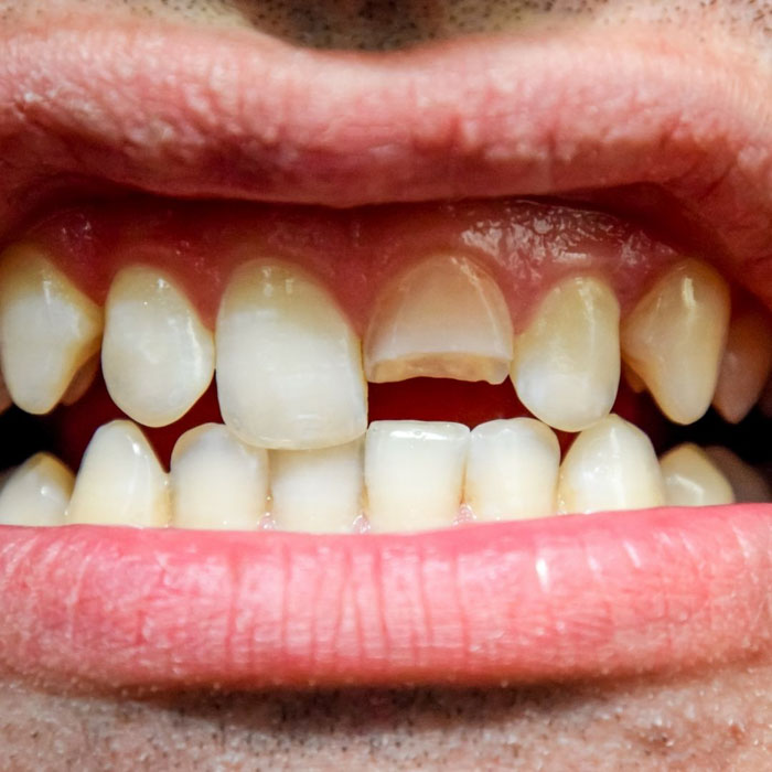 Răng bị sứt mẻ do tai nạn, chấn thương