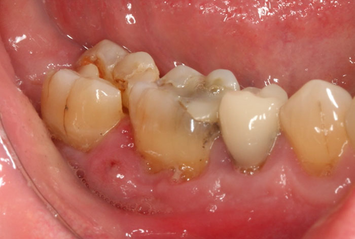 Răng có thể bị nứt gãy do gặp các ngoại lực mạnh từ bên ngoài