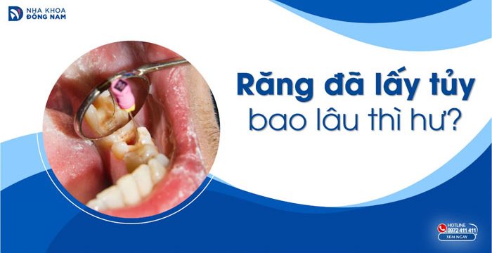 Răng đã lấy tủy bao lâu thì hư?