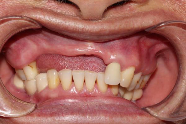Răng giả tháo lắp không khắc phục được tình trạng tiêu xương hàm