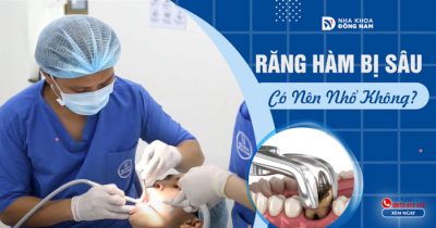 Răng Hàm Bị Sâu Có Nên Nhổ Không?