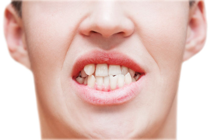 Răng khấp khểnh có thể là do di truyền hoặc xảy ra trong quá trình phát triển