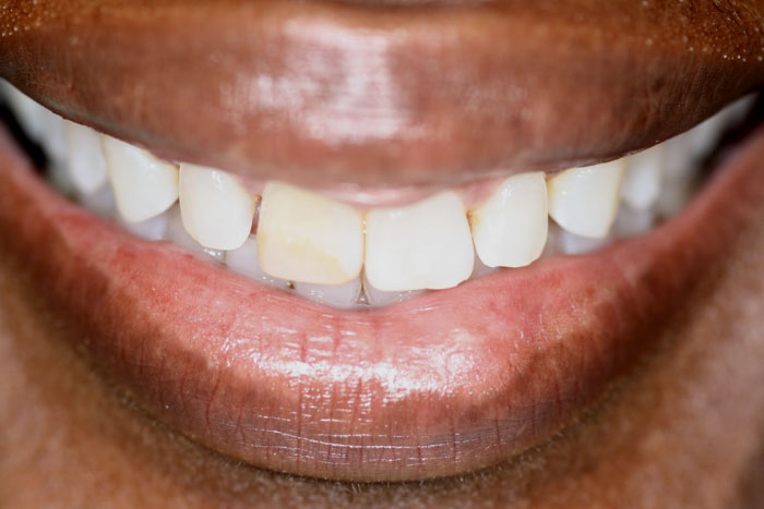 Răng không đều màu sau khi tẩy trắng