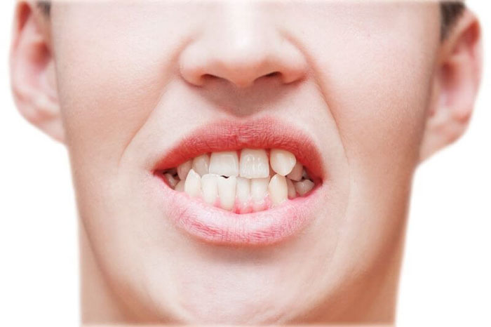 Răng lòi sĩ ảnh hưởng đến thẩm mỹ nụ cười