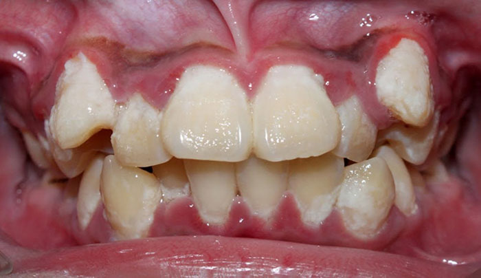 Răng lòi sĩ khó vệ sinh và dễ mắc bệnh lý