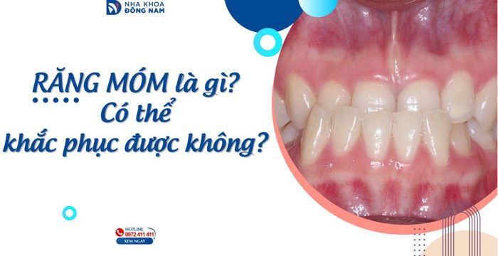 Răng móm là gì? Có thể khắc phục được không?