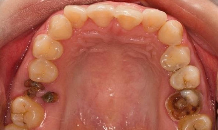 Răng sâu chỉ còn chân răng nên nhổ bỏ sớm