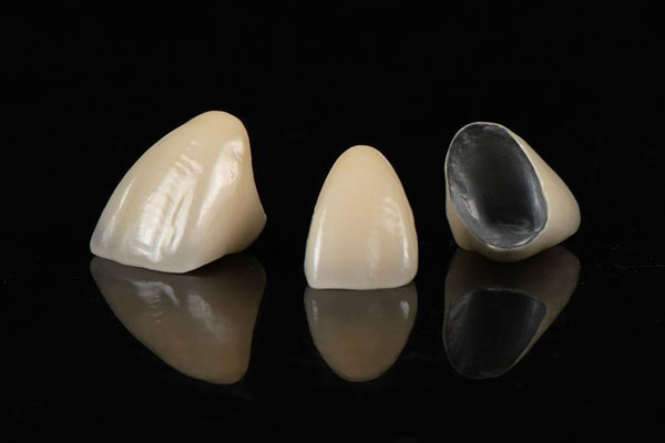 Răng sứ kim loại có khung sườn bên trong từ hợp kim