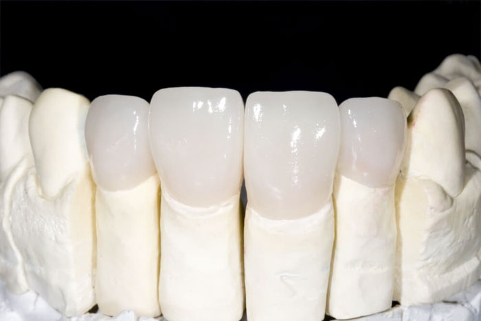 Răng sứ Zirconia toàn khối