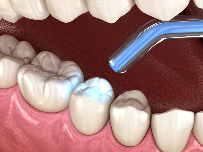 Trám răng đã lấy tủy giúp cải thiện thẩm mỹ, ăn nhai tốt hơn