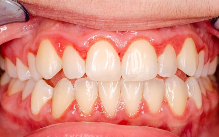 Viêm chân răng giai đoạn cấp tính