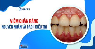 Viêm Chân Răng – Nguyên Nhân Và Cách Điều Trị