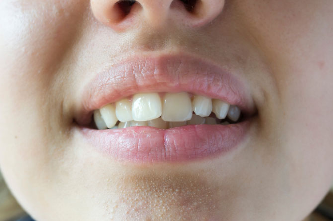 Bọc sứ cho trường hợp răng lệch lạc nhẹ
